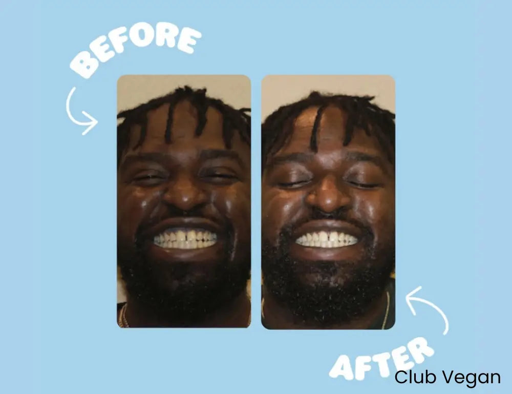 Teeth Whitening Kit – Natuurlijke Tandenbleek Set